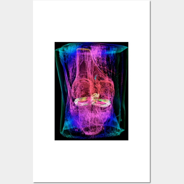 Knee menisci and ligaments, 3D MRI scan (C037/4594) Wall Art by SciencePhoto